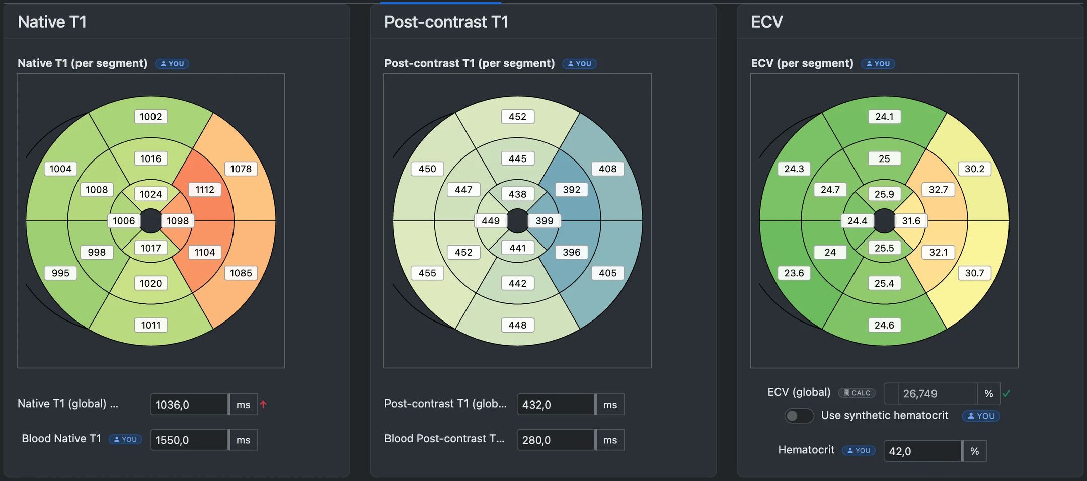 CMR parametric mapping: native T1, post-contrast T1 and ECV bulls-eye maps with a value on every AHA segment, colour-scaled, above the global values, blood T1 and haematocrit.
